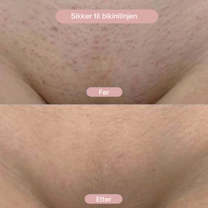 SilkGlide™ – Din hud fortjener kun det bedste